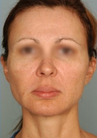 Lifting facial caso 1 — antes
